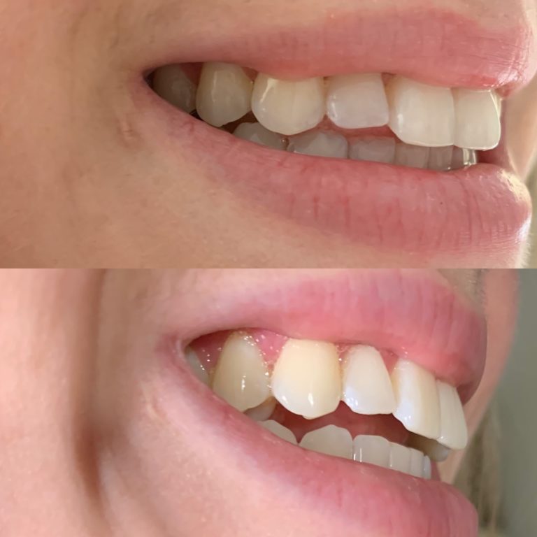 At Home Teeth Whitening: Does it Really Work? - Steph Read Blog